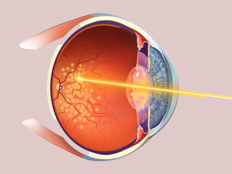 Retinopathy of Prematurity (ROP) Stages