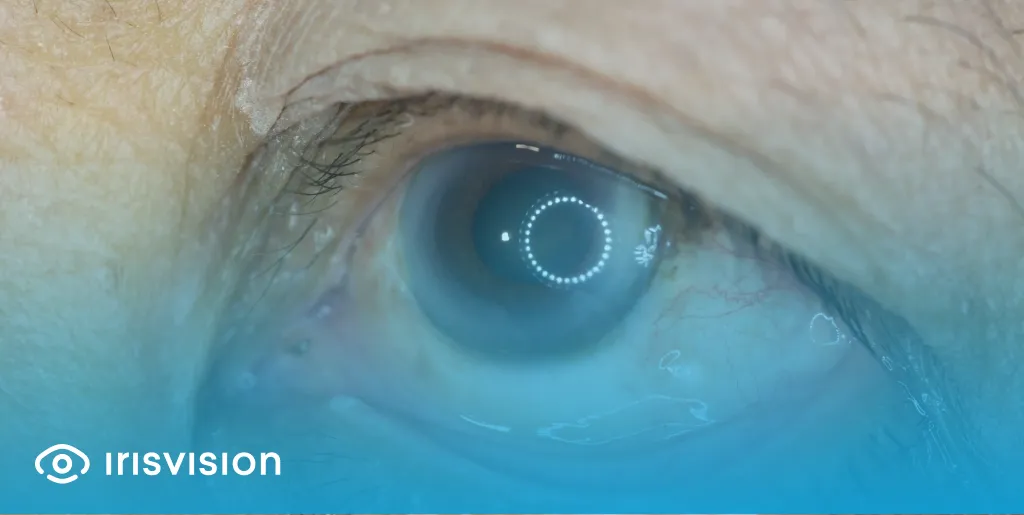 Stages of DR: Non-Proliferative and Proliferative Diabetic Retinopathy