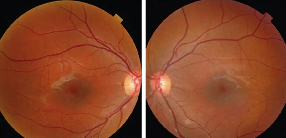 Is There Any Treatment for Stargardt Disease?
