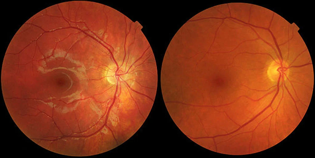 Guide about Age Related Macular Degeneration & AMD