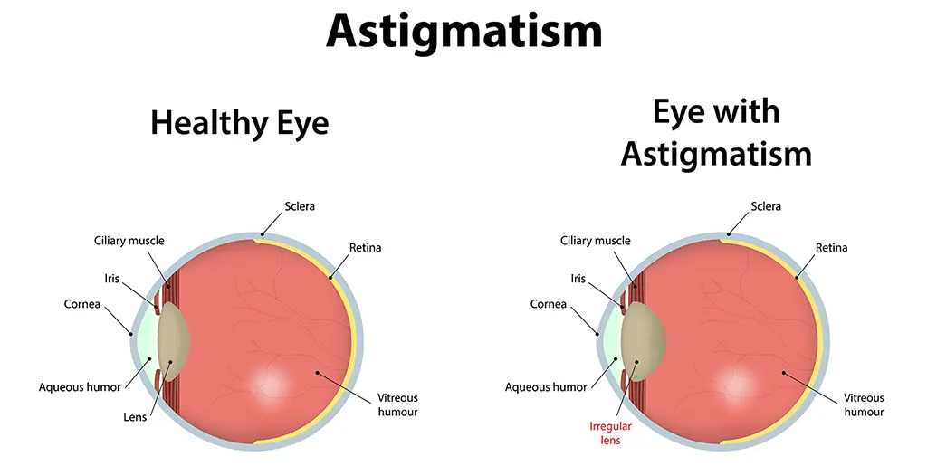 Astigmatism – Understanding the Basics of a Common Eye Condition