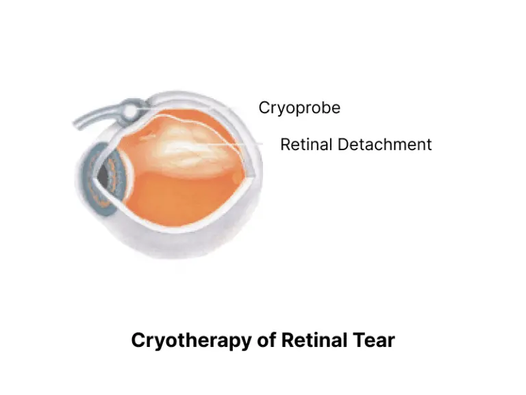 Close-up of an eye during a cryotherapy retinal procedure