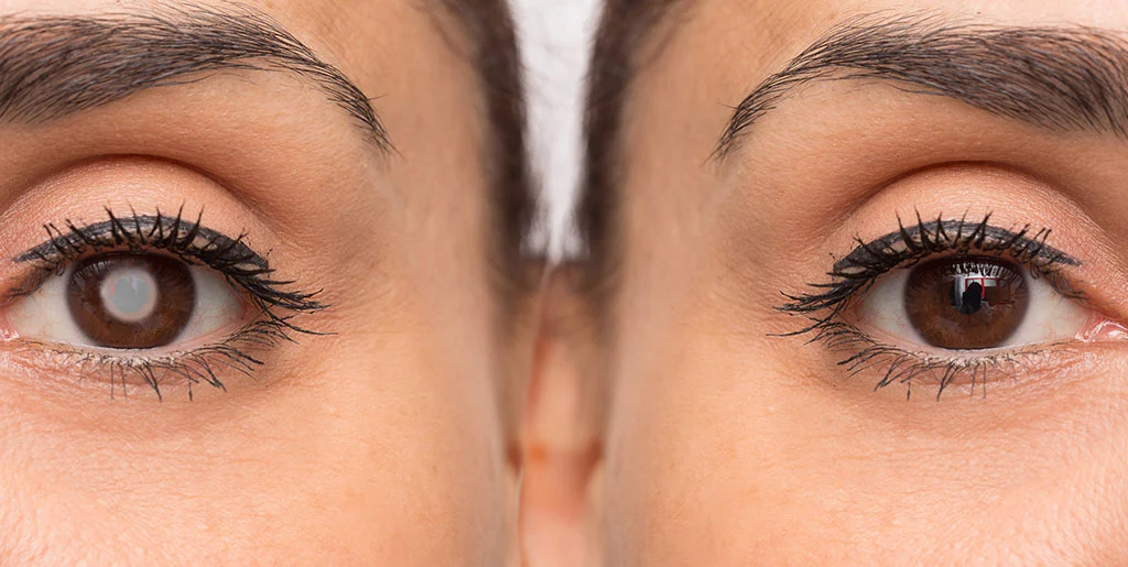 Cataract Prevention – 7 Tips to Prevent Cataracts Naturally