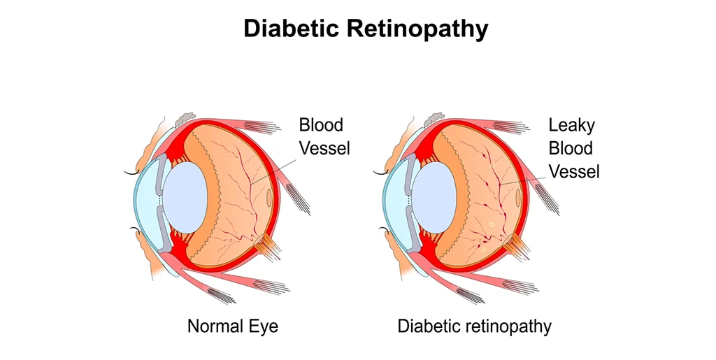 Are There Different Types of Diabetic Retinopathy?
