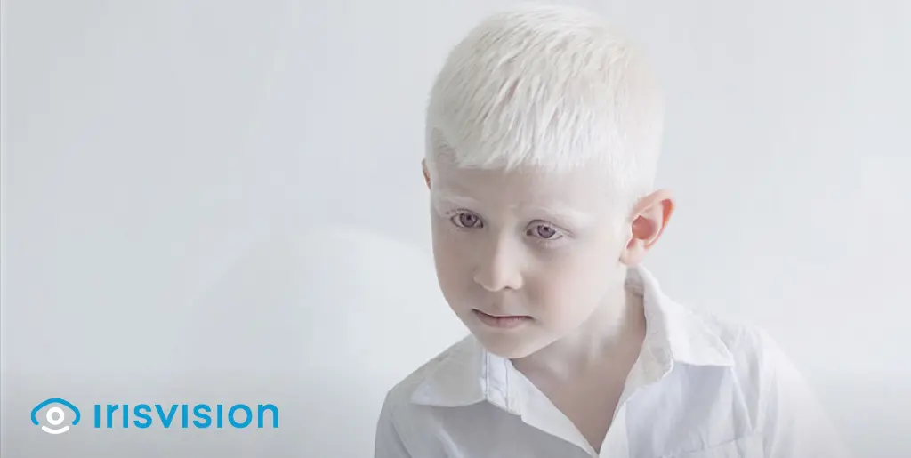 Ocular Albinism and its Prevalence in Males