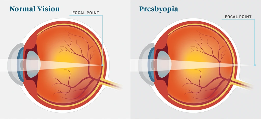 Presbyopia – A Common Eye Condition Related to Aging