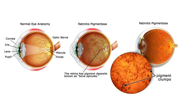What is Retinitis Pigmentosa: Exploring the Causes and Symptoms