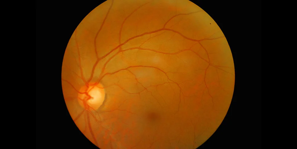 Retinitis Pigmentosa – The Disease and Some Viable Treatment Options