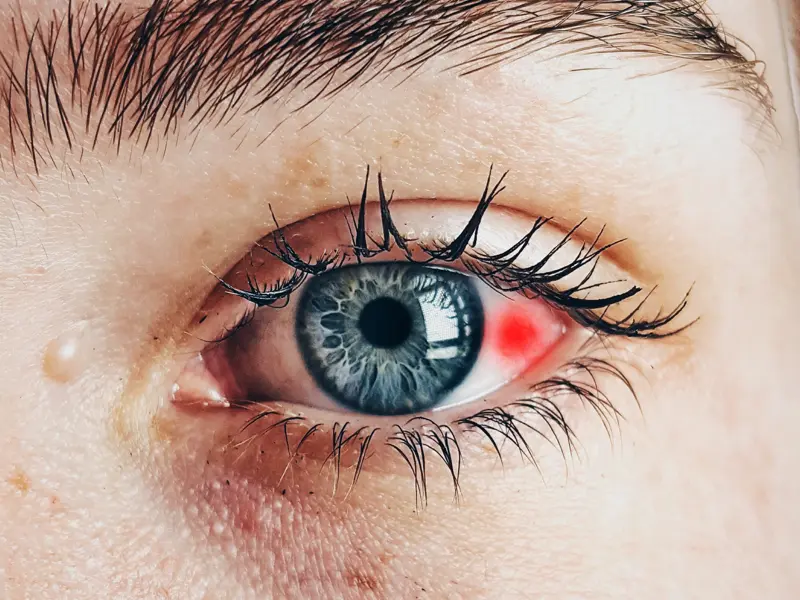 Close-up of an eye showing redness and swelling from an injury