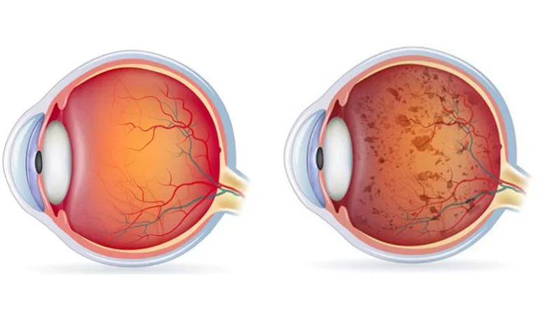 Retinitis Pigmentosa: Things to Consider Fighting this Disease