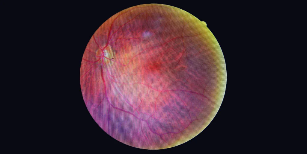 Top 10 Tips for Diabetic Retinopathy Prevention