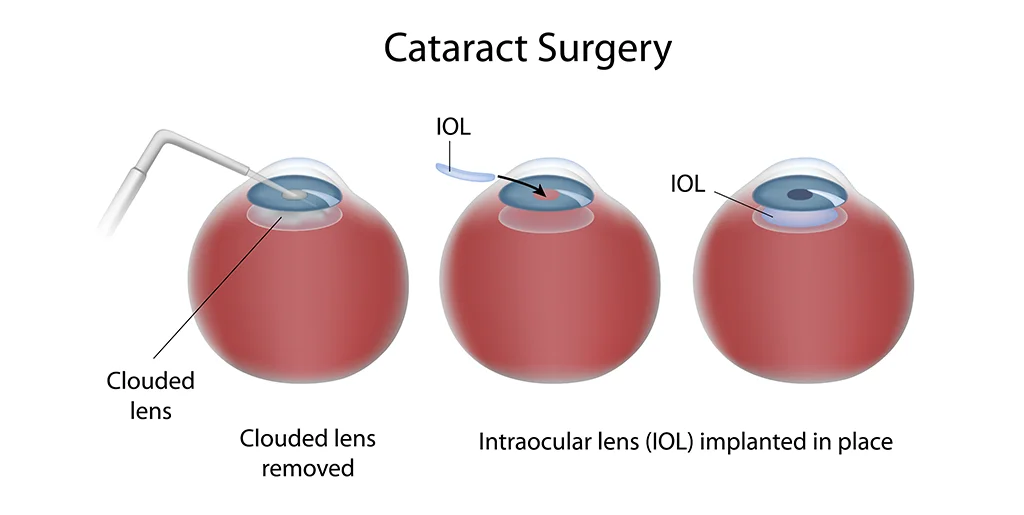 Types of Cataract Surgery – Knowing Your Options Better