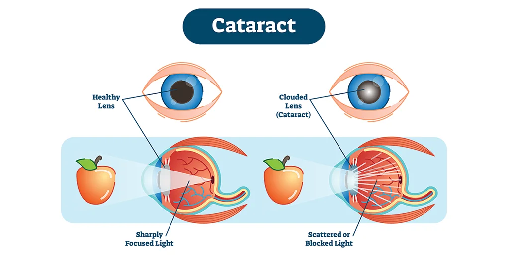 types-of-cataract-surgery