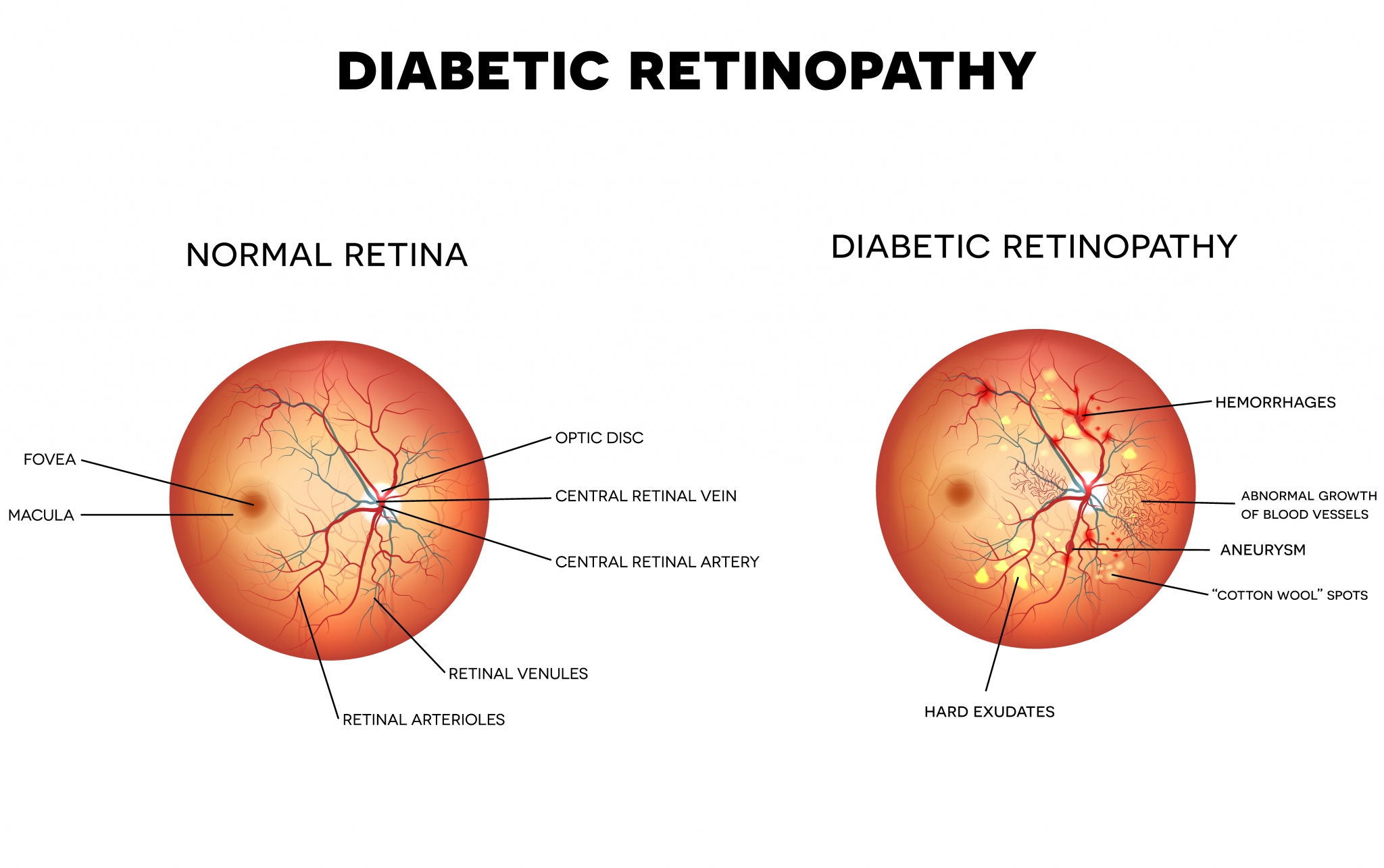 what-causes-diabetic-retinopathy