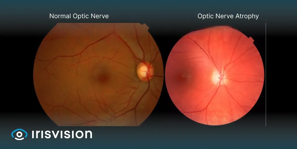 What Diseases Cause Optic Atrophy?