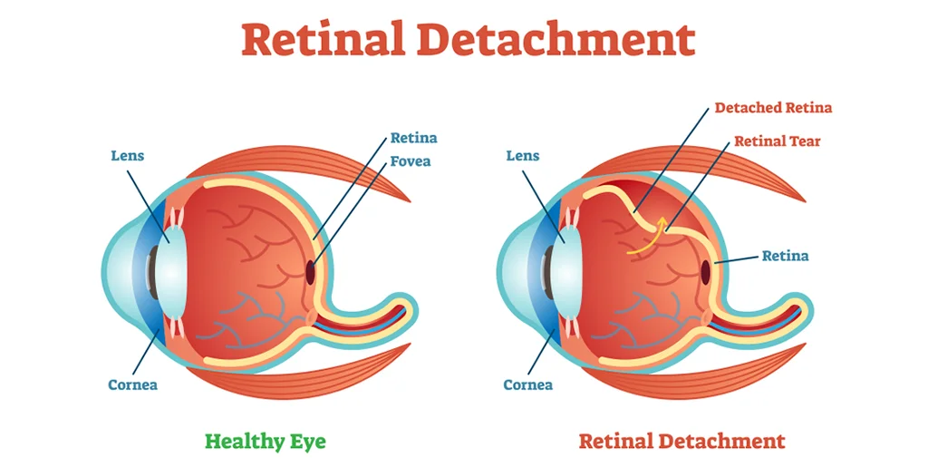 What is Retinal Detachment? Exploring Various Types, Causes and Treatments