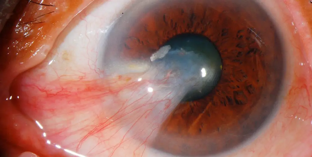 What is Uveitis? Causes, Symptoms and Treatment Options